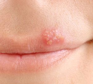 Can You Put a Pimple Patch on a Cold Sore &amp; What Happens if You Do?