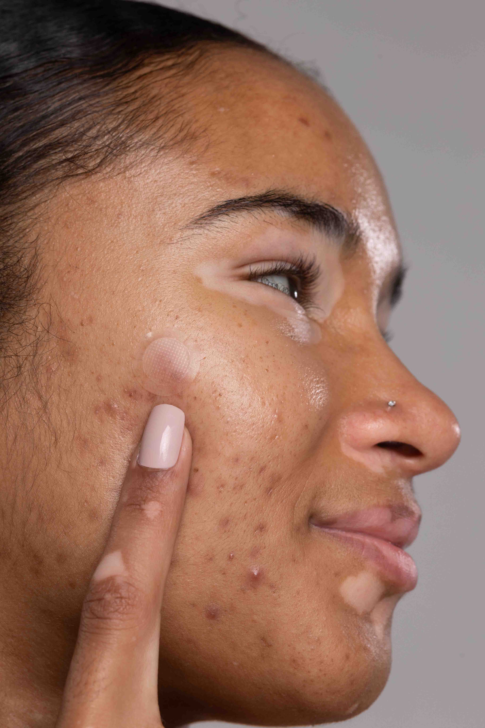 Do Pimple Patches Leave Scars? Are They Helping or a Cause?